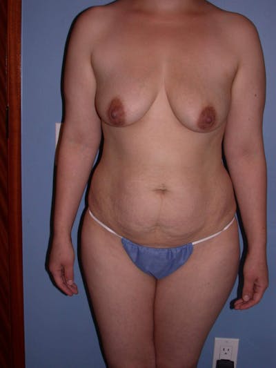 Tummy Tuck Gallery Before & After Gallery - Patient 4756879 - Image 1