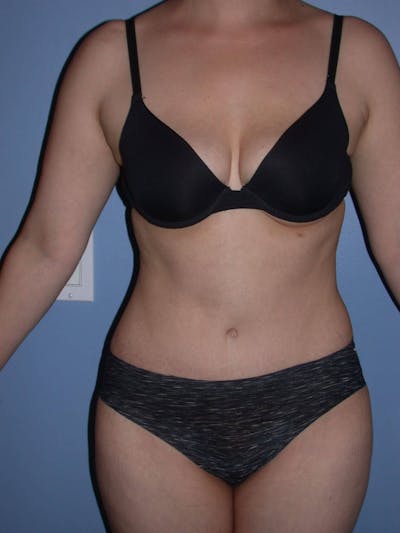 Tummy Tuck Gallery - Patient 4756879 - Image 2