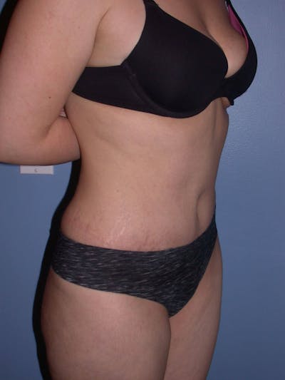 Tummy Tuck Before & After Gallery - Patient 4756879 - Image 4