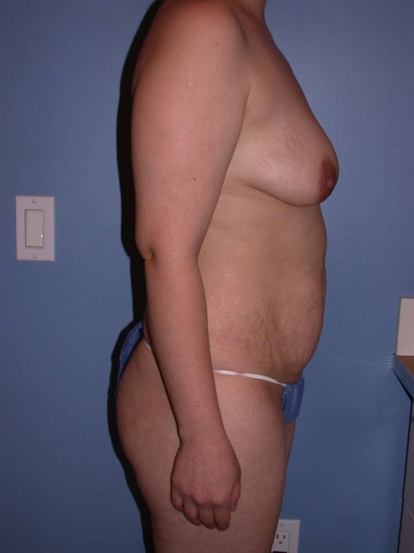 Tummy Tuck Gallery Before & After Gallery - Patient 4756879 - Image 5
