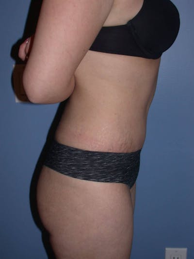 Tummy Tuck Gallery Before & After Gallery - Patient 4756879 - Image 6