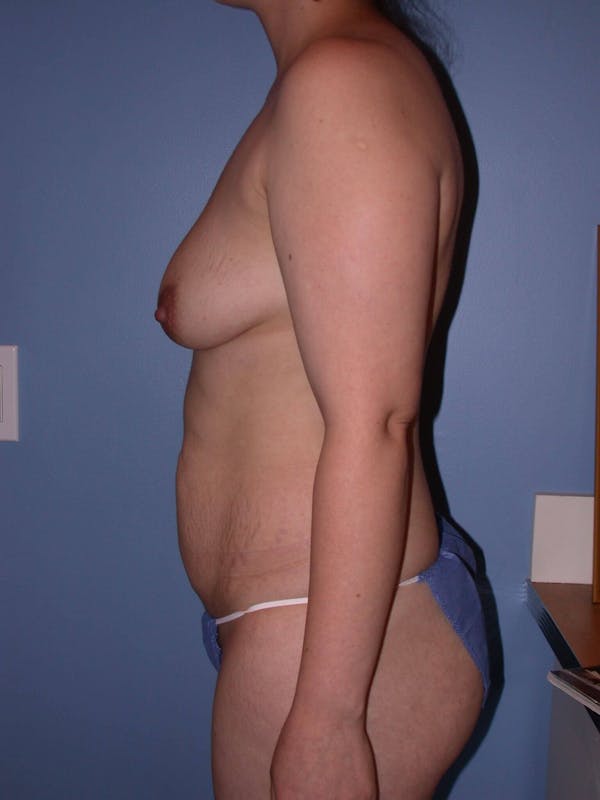 Tummy Tuck Gallery Before & After Gallery - Patient 4756879 - Image 7