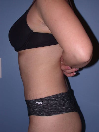 Tummy Tuck Gallery Before & After Gallery - Patient 4756879 - Image 8