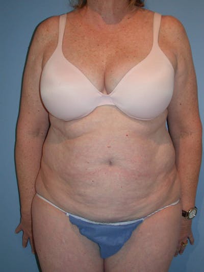 Tummy Tuck Gallery Before & After Gallery - Patient 4756884 - Image 1