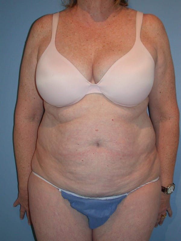 Tummy Tuck Before & After Gallery - Patient 4756884 - Image 1