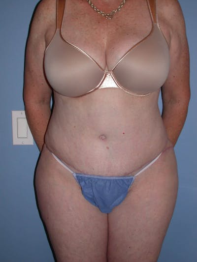 Tummy Tuck Gallery Before & After Gallery - Patient 4756884 - Image 2