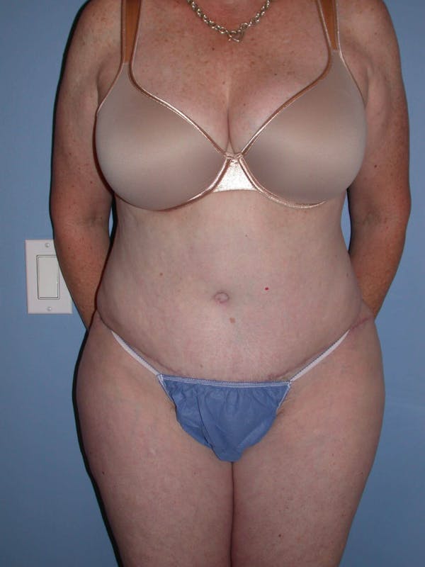 Tummy Tuck Gallery - Patient 4756884 - Image 2