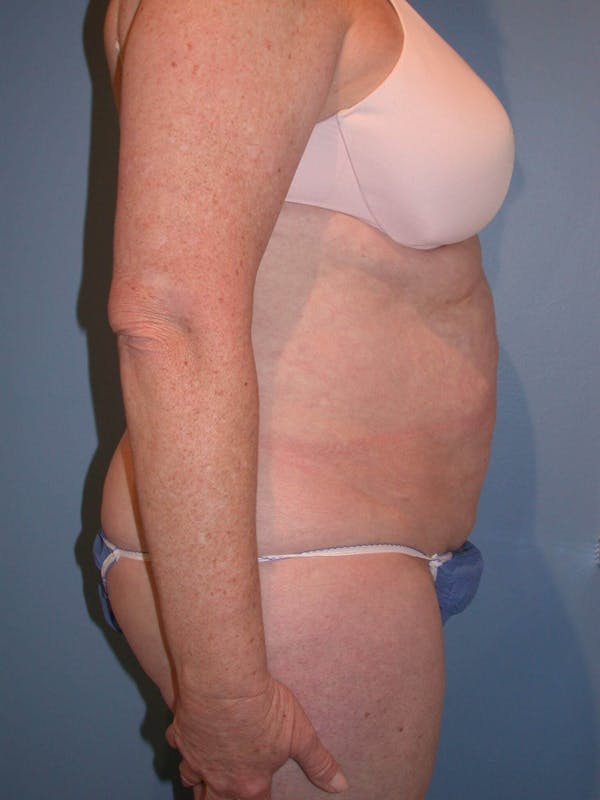 Tummy Tuck Gallery Before & After Gallery - Patient 4756884 - Image 3