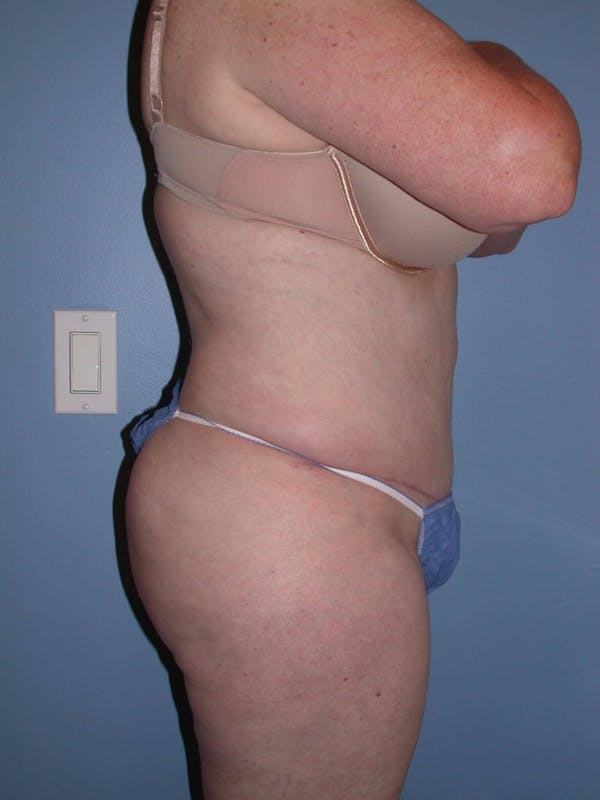 Tummy Tuck Gallery Before & After Gallery - Patient 4756884 - Image 4