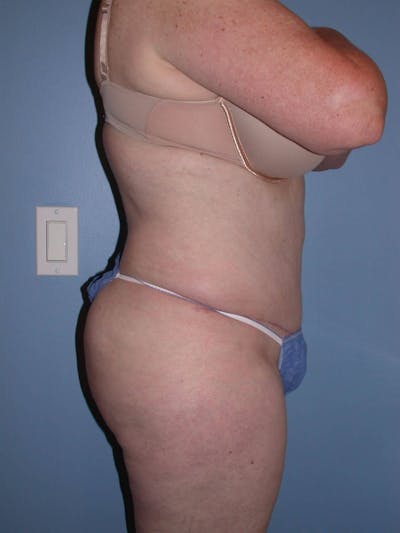 Tummy Tuck Before & After Gallery - Patient 4756884 - Image 4