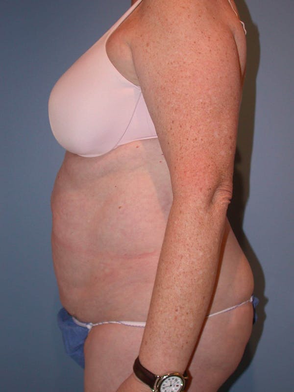 Tummy Tuck Gallery Before & After Gallery - Patient 4756884 - Image 5