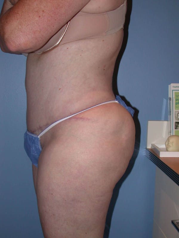Tummy Tuck Gallery Before & After Gallery - Patient 4756884 - Image 6
