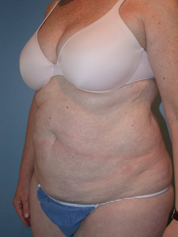 Tummy Tuck Gallery Before & After Gallery - Patient 4756884 - Image 7
