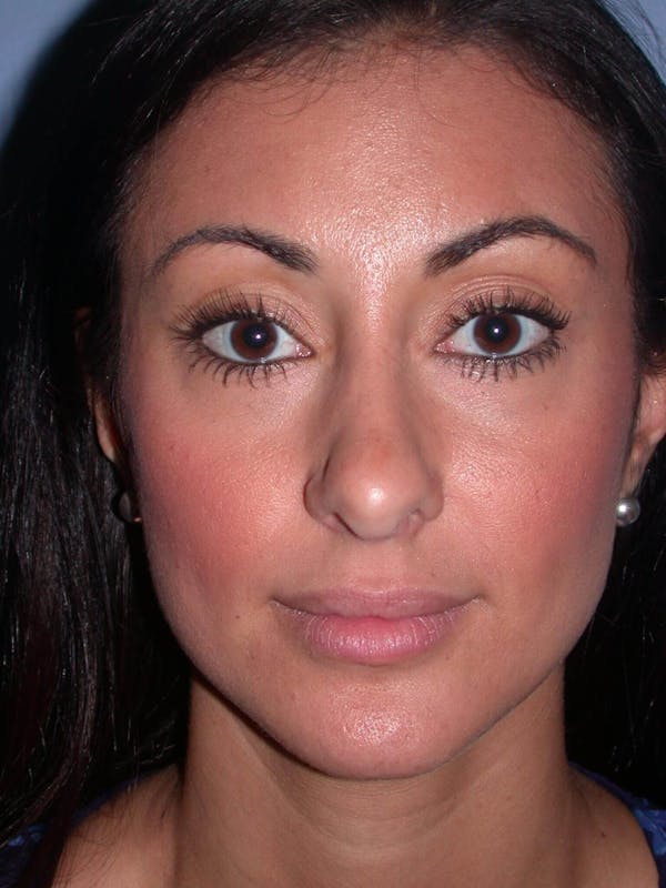 Juvederm