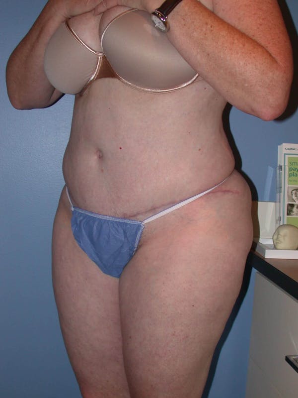 Tummy Tuck Gallery Before & After Gallery - Patient 4756884 - Image 8