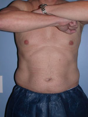 CoolSculpting