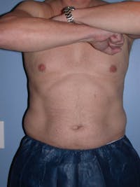 CoolSculpting Gallery Before & After Gallery - Patient 4756889 - Image 1