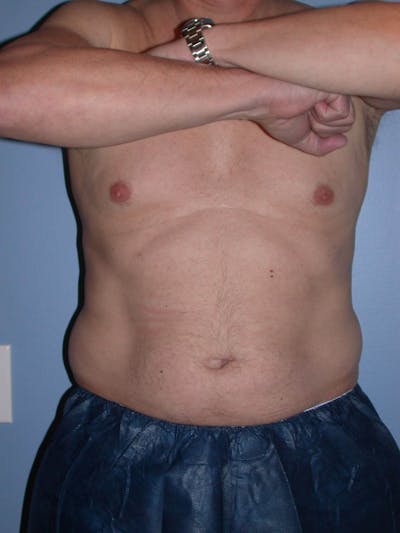 CoolSculpting Gallery Before & After Gallery - Patient 4756889 - Image 1