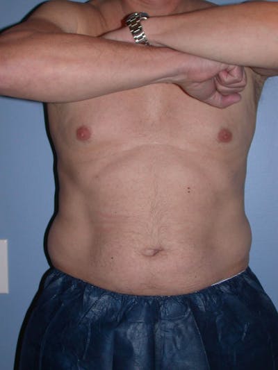 CoolSculpting Gallery - Patient 4756889 - Image 1
