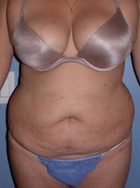 Tummy Tuck Gallery Before & After Gallery - Patient 4756890 - Image 1