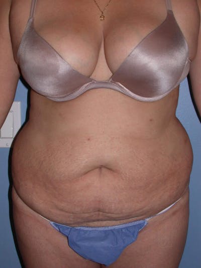 Tummy Tuck Before & After Gallery - Patient 4756890 - Image 1
