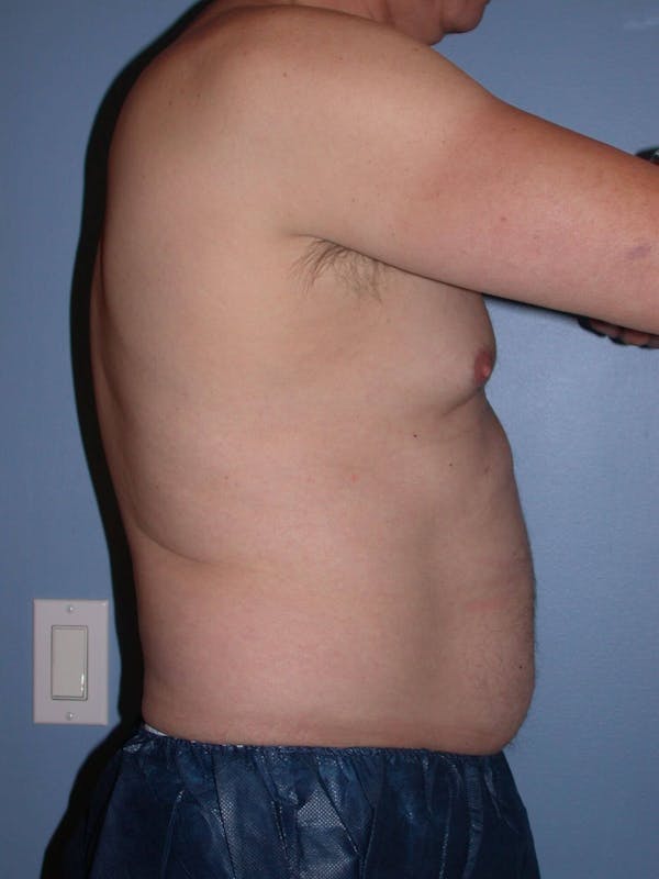 CoolSculpting Gallery Before & After Gallery - Patient 4756889 - Image 3
