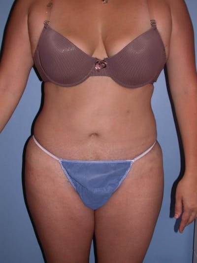 Tummy Tuck Gallery - Patient 4756890 - Image 2