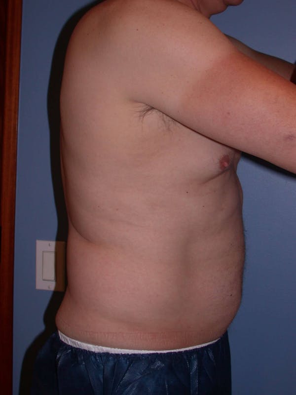 CoolSculpting Gallery Before & After Gallery - Patient 4756889 - Image 4