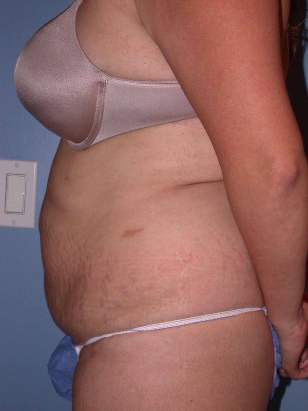 Tummy Tuck Gallery Before & After Gallery - Patient 4756890 - Image 3