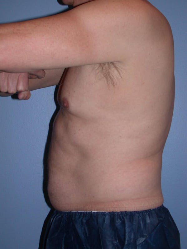 CoolSculpting Gallery Before & After Gallery - Patient 4756889 - Image 5