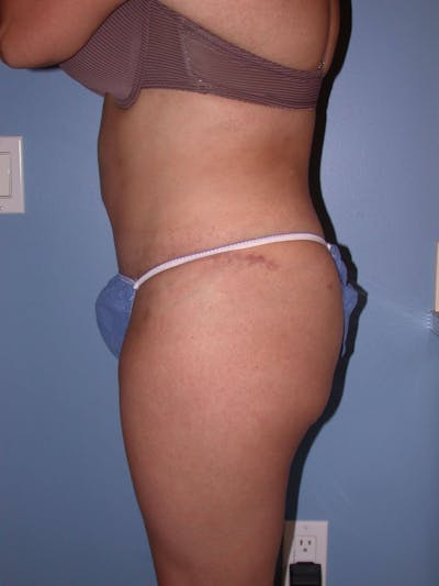 Tummy Tuck Before & After Gallery - Patient 4756890 - Image 4
