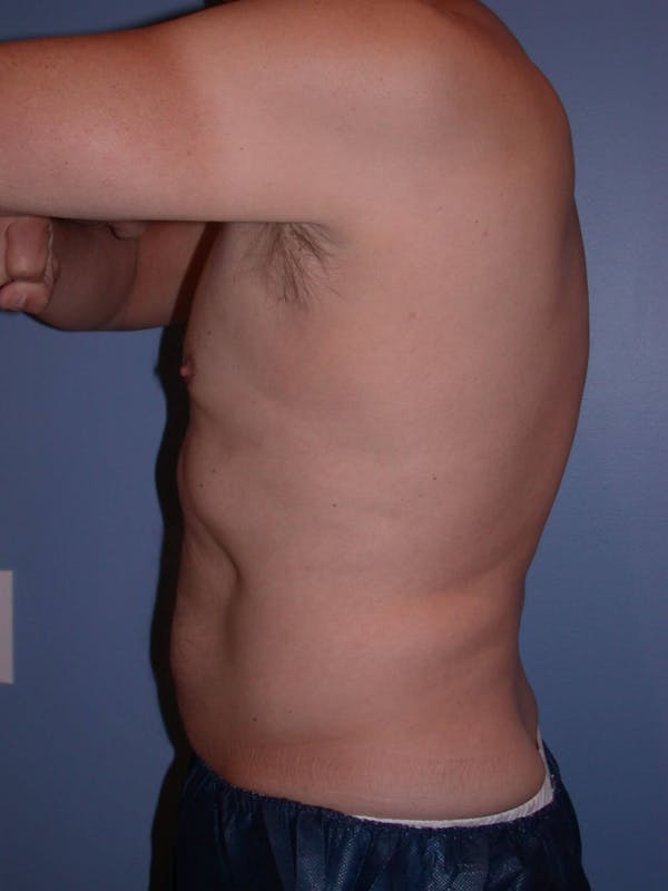 CoolSculpting Gallery Before & After Gallery - Patient 4756889 - Image 6