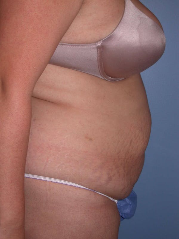 Tummy Tuck Gallery Before & After Gallery - Patient 4756890 - Image 5