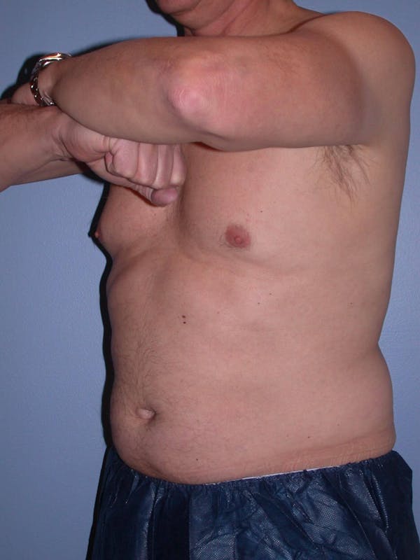 CoolSculpting Gallery Before & After Gallery - Patient 4756889 - Image 7