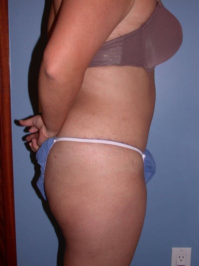 Tummy Tuck Gallery Before & After Gallery - Patient 4756890 - Image 6