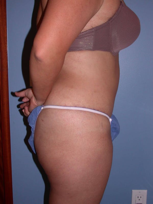 Tummy Tuck Before & After Gallery - Patient 4756890 - Image 6