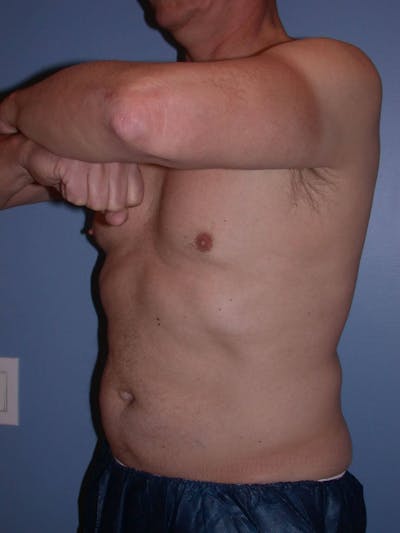 CoolSculpting Gallery Before & After Gallery - Patient 4756889 - Image 8