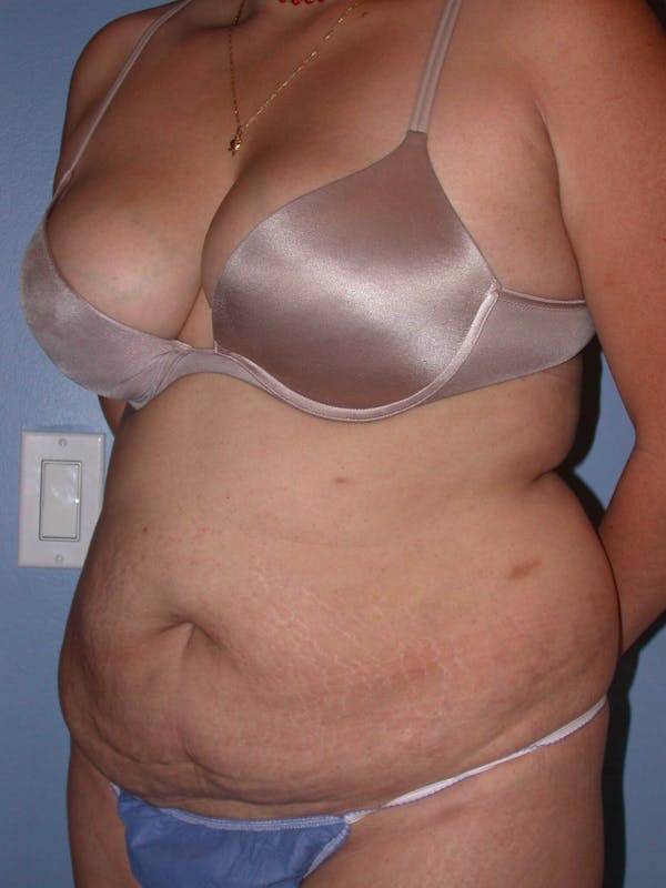 Tummy Tuck Gallery Before & After Gallery - Patient 4756890 - Image 7