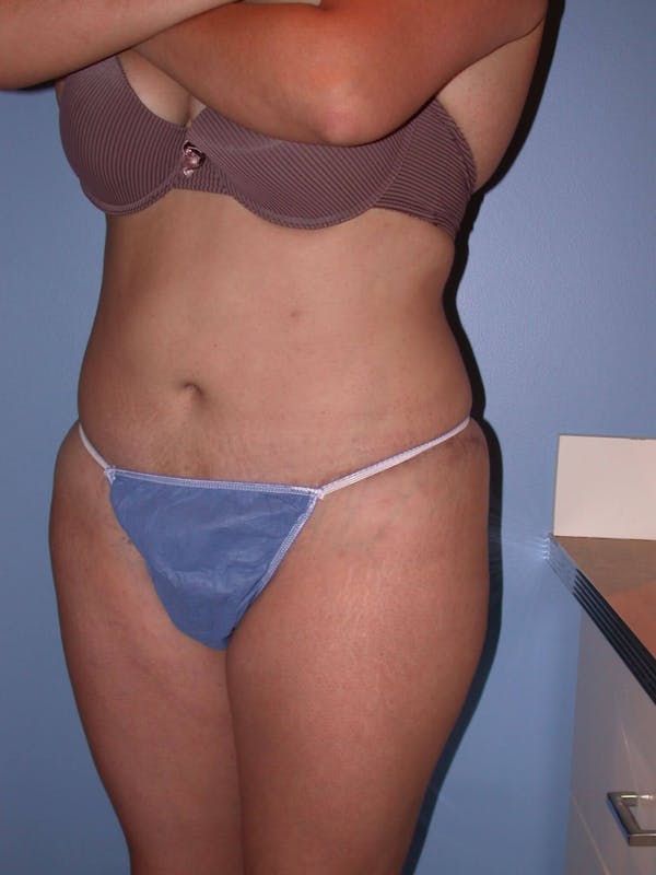 Tummy Tuck Gallery Before & After Gallery - Patient 4756890 - Image 8