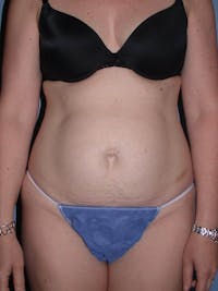 Tummy Tuck Gallery Before & After Gallery - Patient 4756894 - Image 1