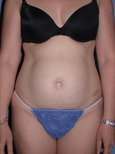 Tummy Tuck Gallery Before & After Gallery - Patient 4756894 - Image 1