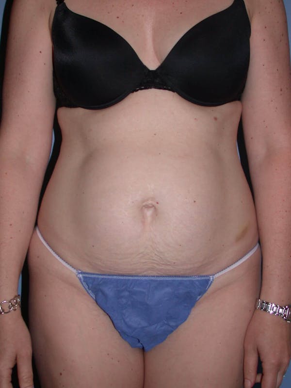 Tummy Tuck Gallery - Patient 4756894 - Image 1