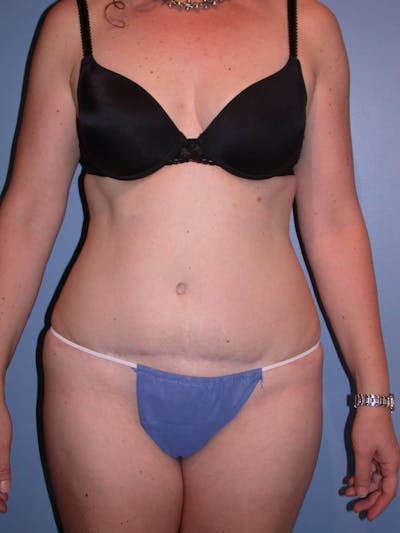 Tummy Tuck Gallery Before & After Gallery - Patient 4756894 - Image 2