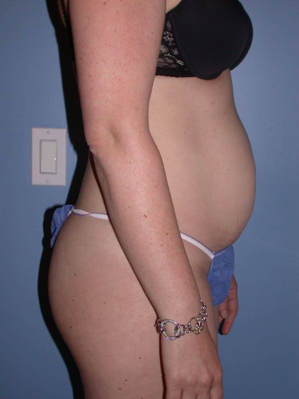 Tummy Tuck Gallery Before & After Gallery - Patient 4756894 - Image 3