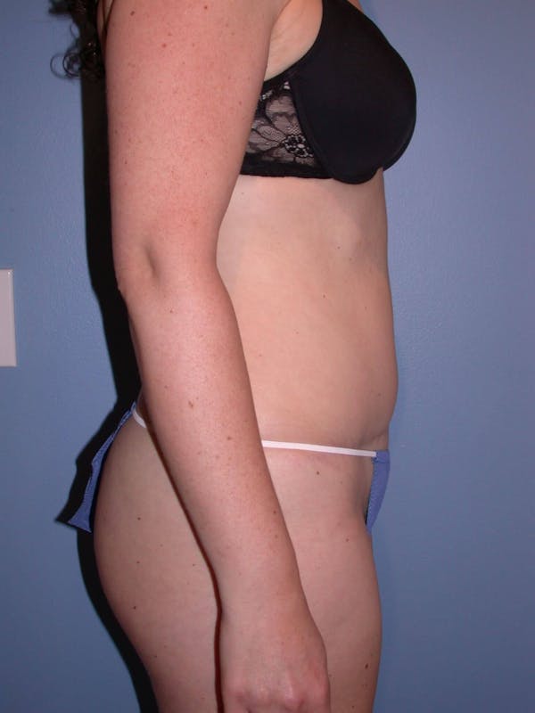 Tummy Tuck Gallery Before & After Gallery - Patient 4756894 - Image 4