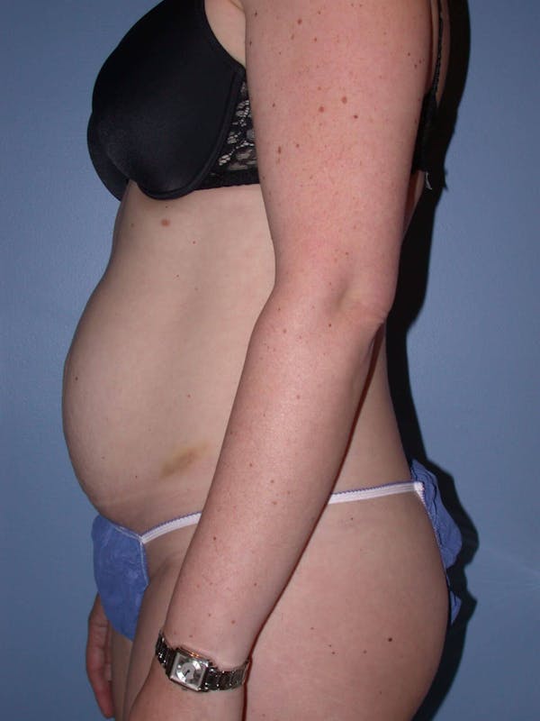 Tummy Tuck Gallery Before & After Gallery - Patient 4756894 - Image 5