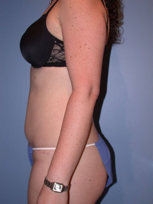 Tummy Tuck Gallery Before & After Gallery - Patient 4756894 - Image 6