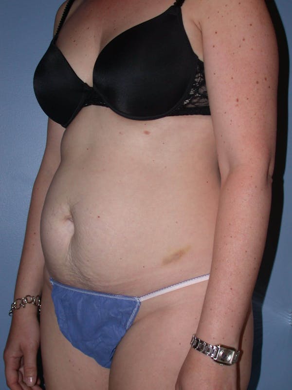 Tummy Tuck Gallery Before & After Gallery - Patient 4756894 - Image 7
