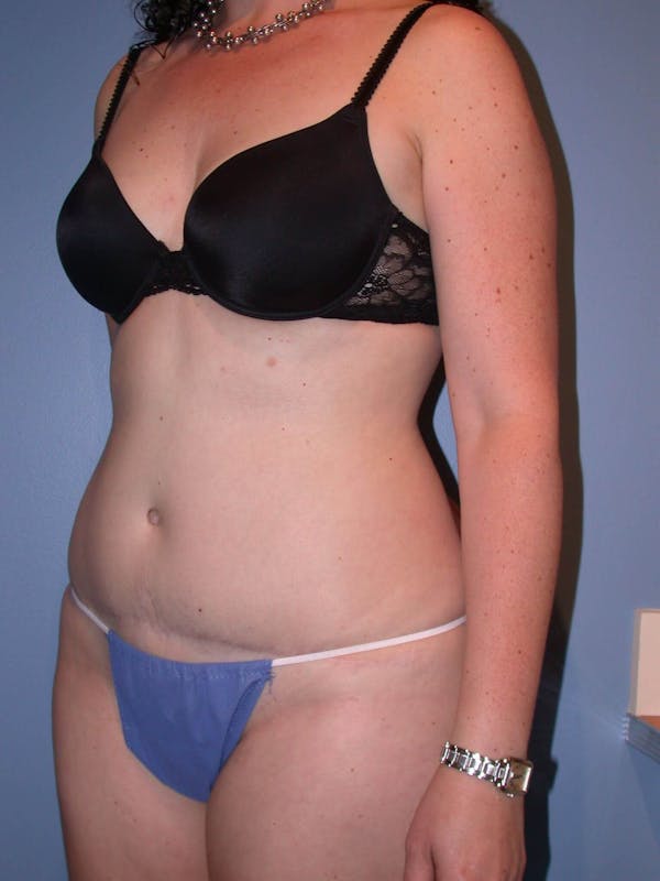Tummy Tuck Gallery Before & After Gallery - Patient 4756894 - Image 8