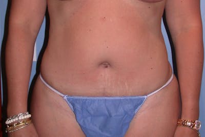 Tummy Tuck Gallery Before & After Gallery - Patient 4756899 - Image 2